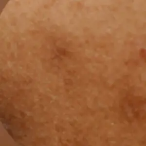 Skin Discoloration and Uneven Skin Tone