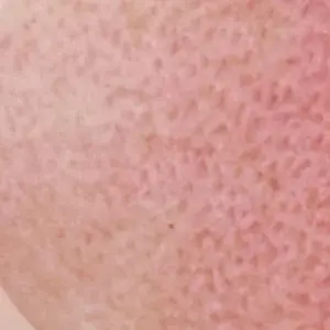 Skin Redness