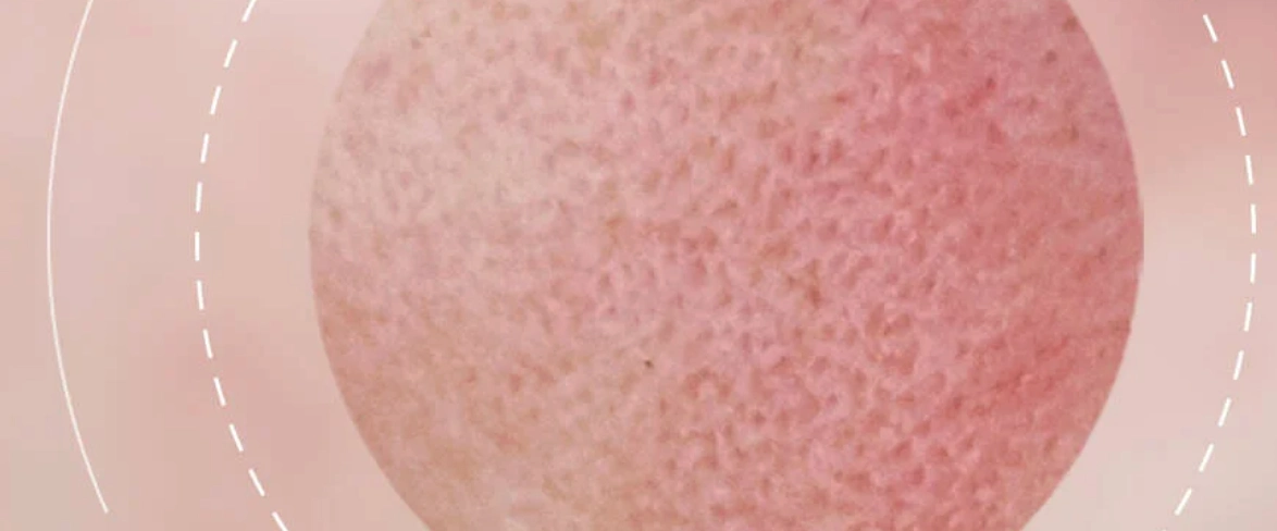 Skin Redness