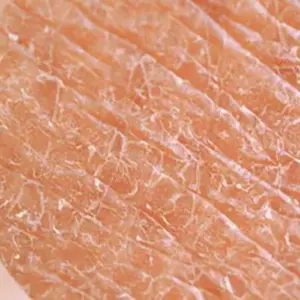 Dehydrated Skin