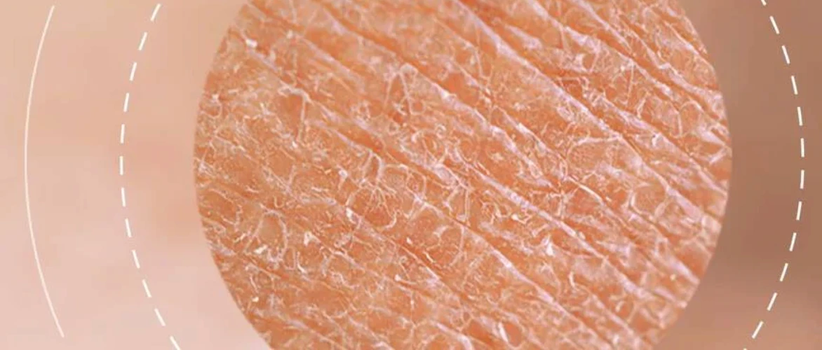 Dehydrated Skin