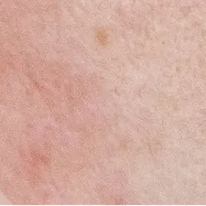Skincare for Sensitivity